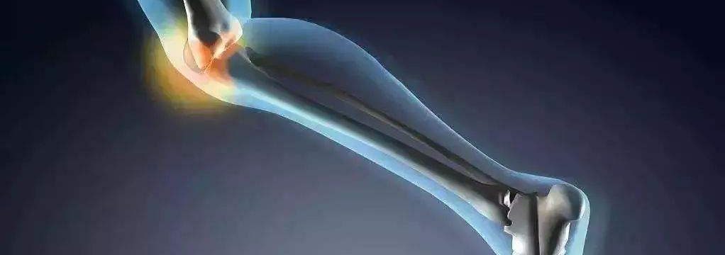 Hyaluronic acid for arthritis