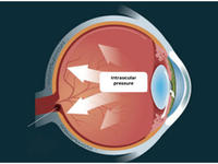 sodium hyaluronate for eyes
